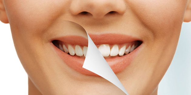 Laminate Veneer (Yaprak  porselen) uygulaması